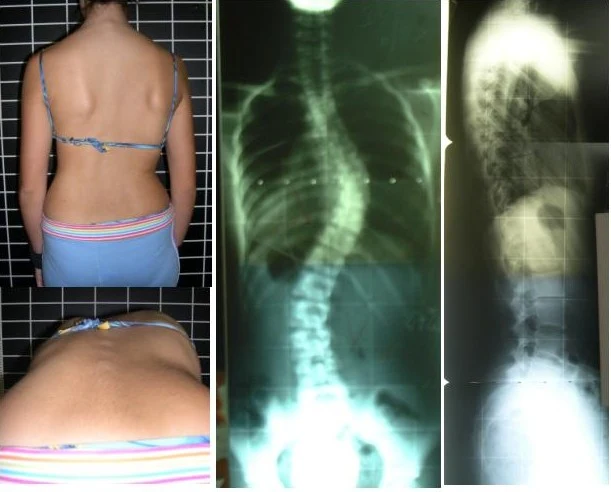 Testul de aplecare Adams și radiografii de scolioză
