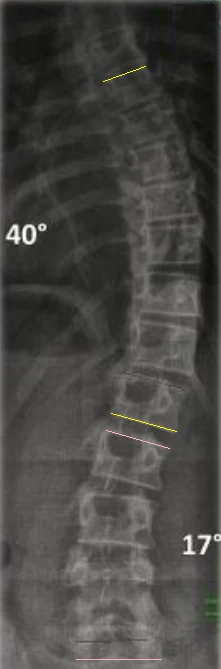 Radiografie de coloană cu unghiul Cobb măsurat