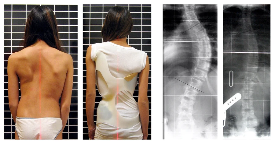 Pacientă purtând un corset Chêneau