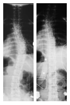 Corecția scoliozei vizibilă pe radiografie, cu și fără corset